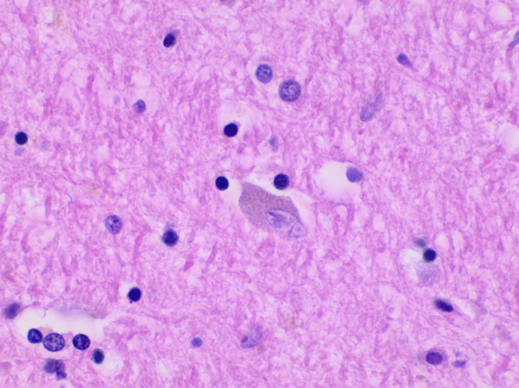 Microscopic view of brain tissue showing amyloid plaques and tau tangles