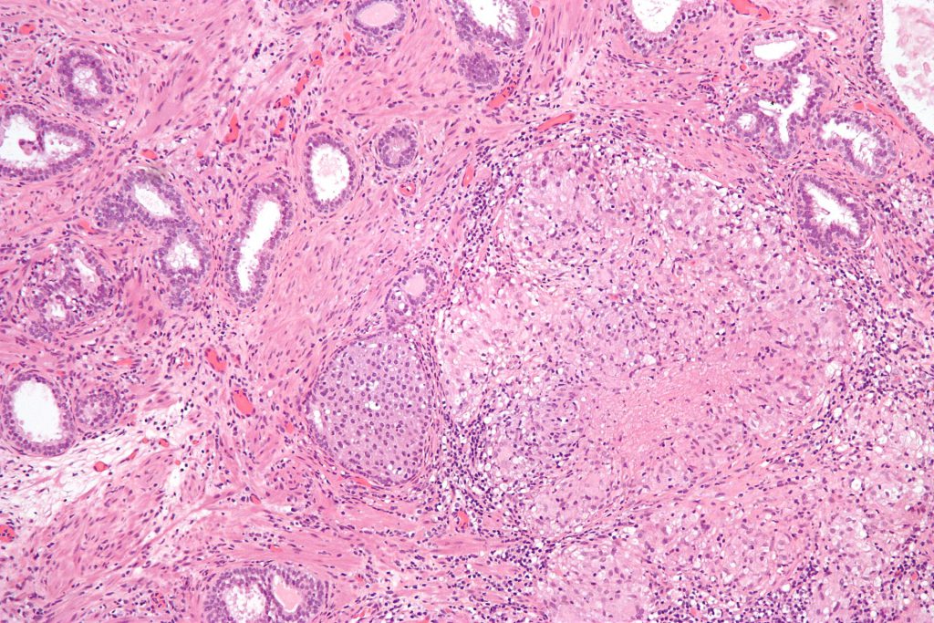 Anktiva medication vial for BCG-unresponsive bladder cancer treatment