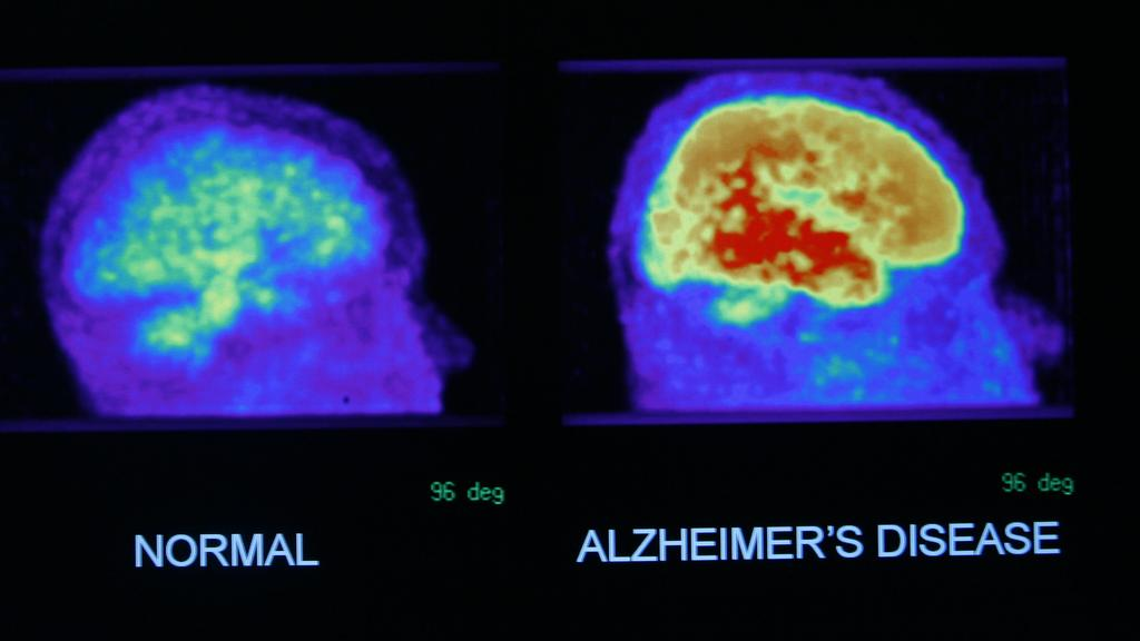 Groundbreaking Advances in Alzheimer's Diagnosis: Blood Tests for Early Detection 4