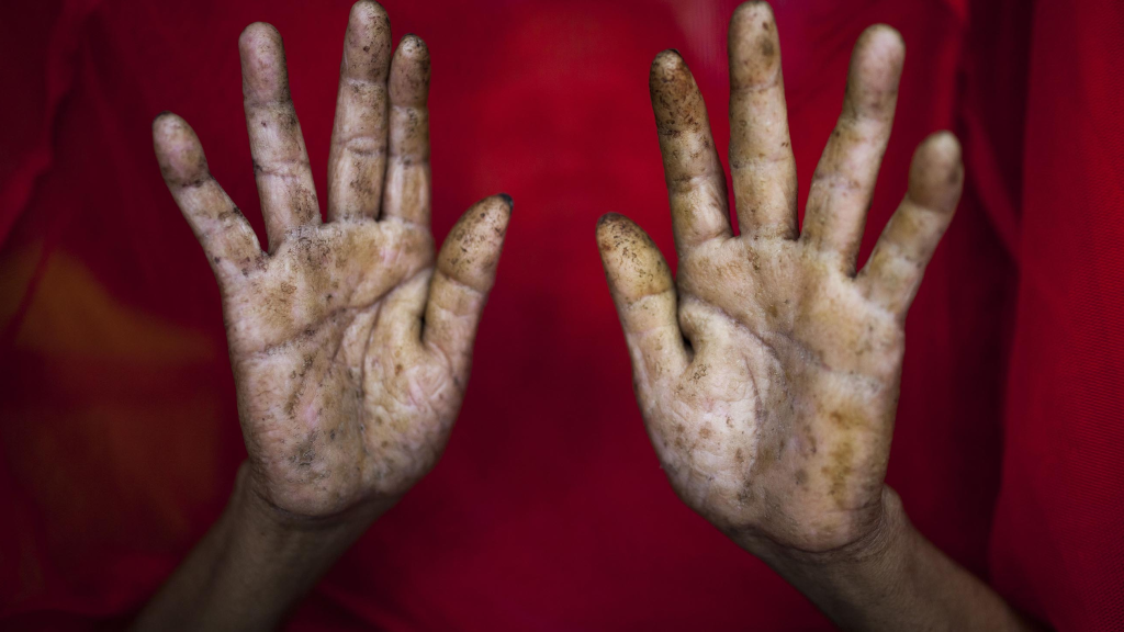 Walmart Recalls Great Value Apple Juice Due to Elevated Arsenic Levels 3 Long-term exposure to arsenic can lead to skin disorders, cardiovascular disease, and increased risks of cancers, particularly of the skin, bladder, and lungs. Short-term exposure can result in symptoms like nausea, vomiting, diarrhea, and numbness or burning sensations in the extremities. (Image Credit: Undark.org)