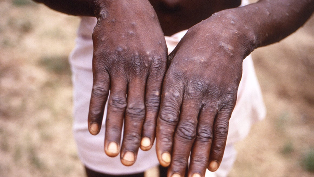 Mpox Outbreak Declared a Global Health Emergency by WHO 1