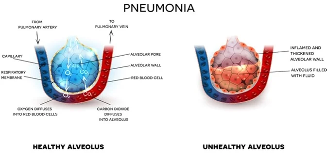 Walking Pneumonia Cases Surge Among Children: What Parents Need to Know 1