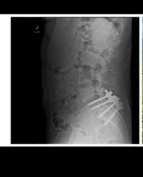 Luigi Mangione: What We Know About UnitedHealthcare CEO Shooter 7 R.J. Martin, Luigi Mangione ex-roommate and friend, told CNN that Mangione sent him these X-rays. This could be the reason why he harbored hatred towards the healthcare systems in America. (Source: CNN)