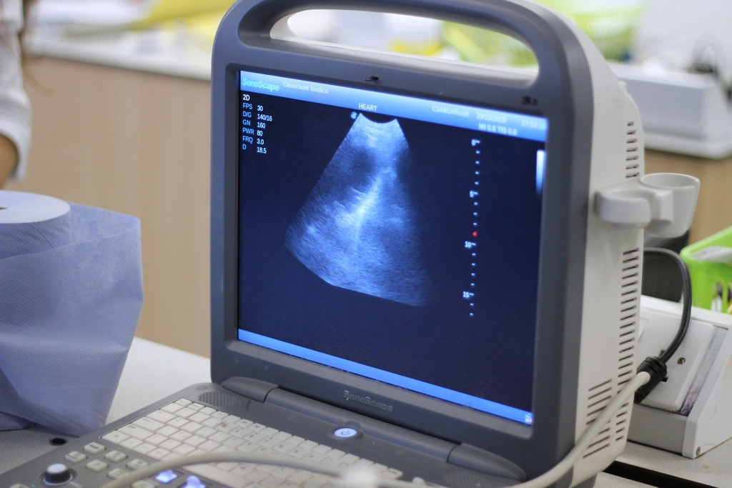 AI Detects Pancreatic Cancer Years Before Symptoms Appear 3 Ultrasound screen monitor medical science