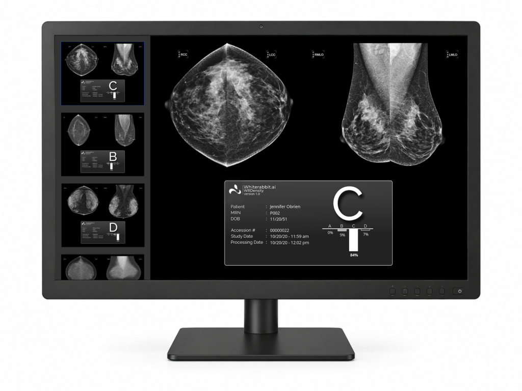 3D ultrasound scan of breast tissue on a medical monitor