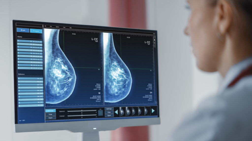 3D ultrasound scan of breast tissue on a medical monitor