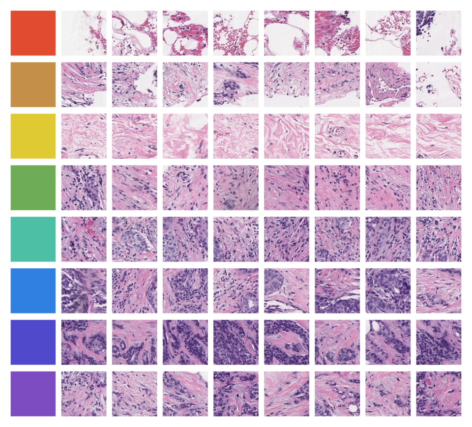 3D ultrasound scan of breast tissue on a medical monitor