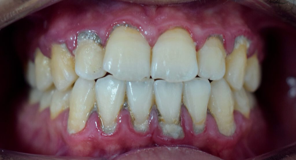 Plaque accumulation