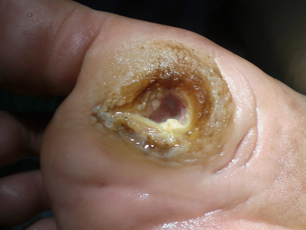 Diabetic Planta ulcer