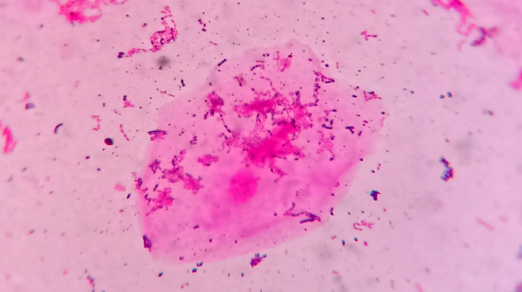 Squamous epithelial cell with oral bacteria