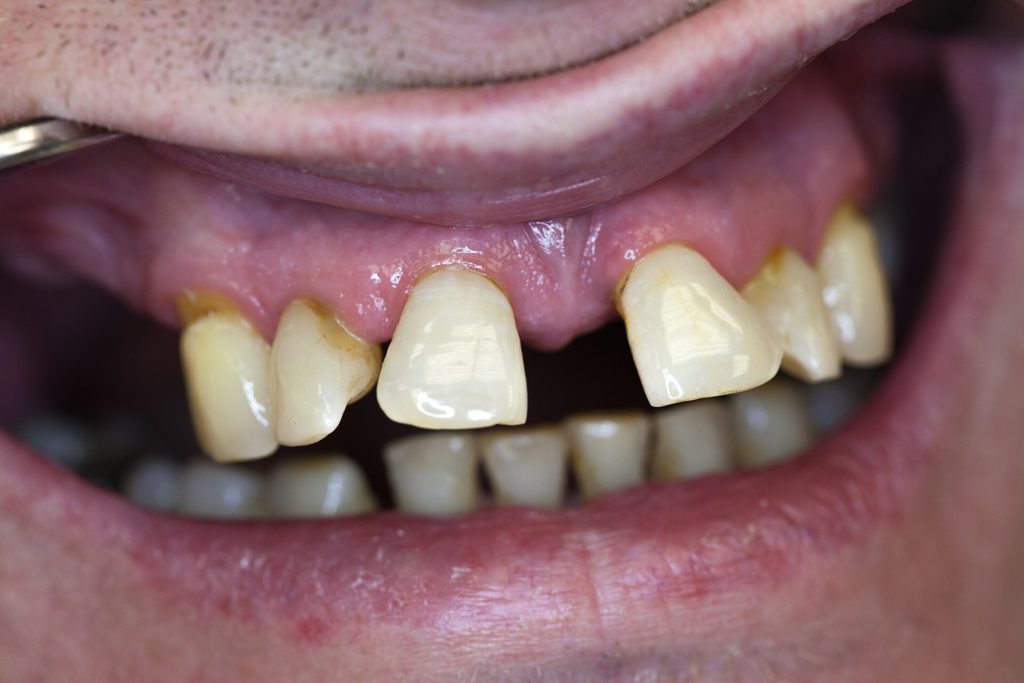 Zahnwanderung wegen Periodontitis OK 05