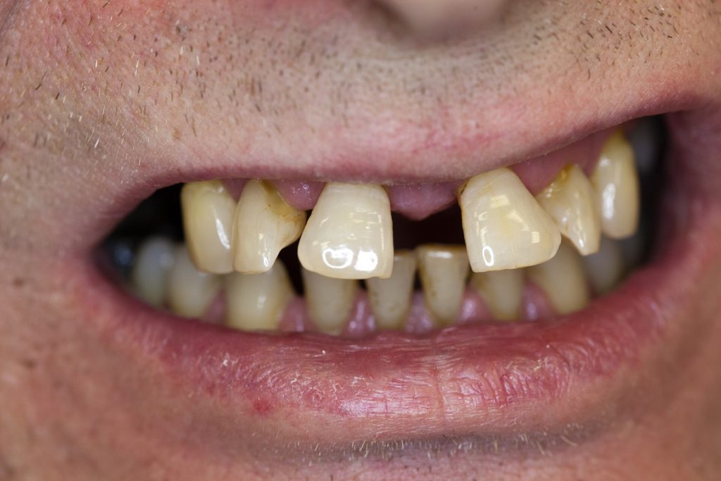 Zahnwanderung wegen Periodontitis OK 03