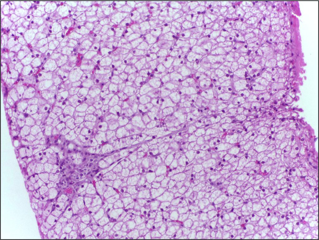 Microscopic view of liver cells showing fatty deposits associated with fatty liver disease