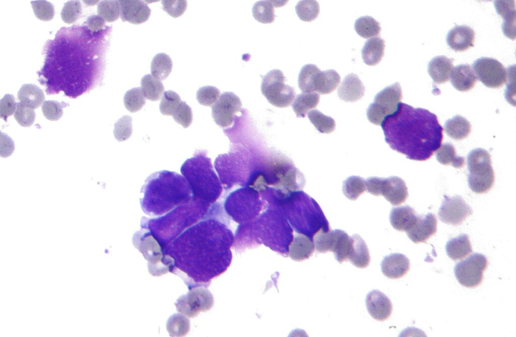 Microscopic view of gamma delta T cells attacking small cell lung cancer cells