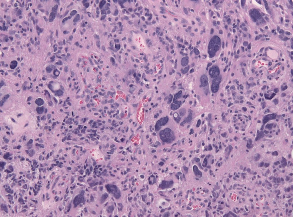 Thick Fluid Makes Glioblastoma Cells More Aggressive 1 Glioblastoma anaplastic cells HE