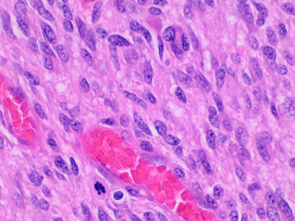 Thick Fluid Makes Glioblastoma Cells More Aggressive 2 Histopathology of glioblastoma, high magnification