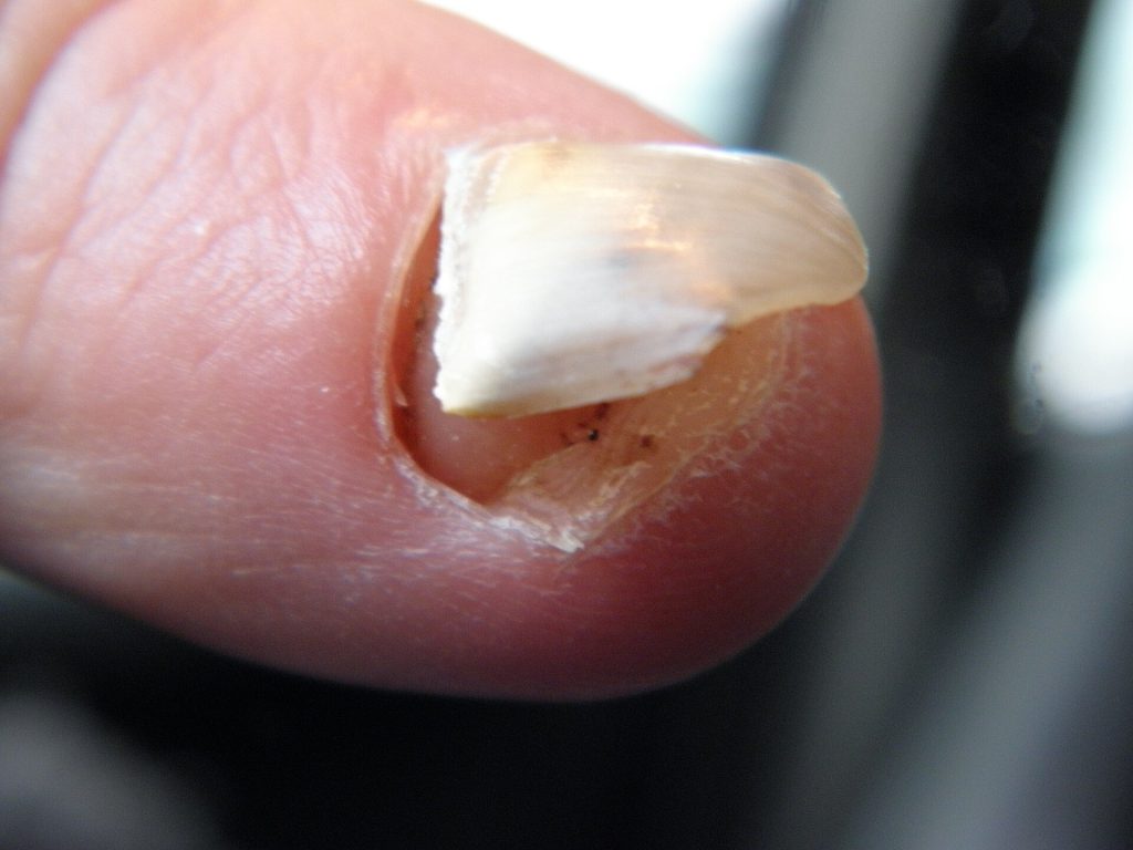 Detachment of a fingernail