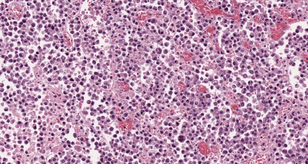 Hidden Aggressive Cells Explain Deadly Childhood Cancer Outcomes 1 Alveolar rhabdomyosarcoma 4