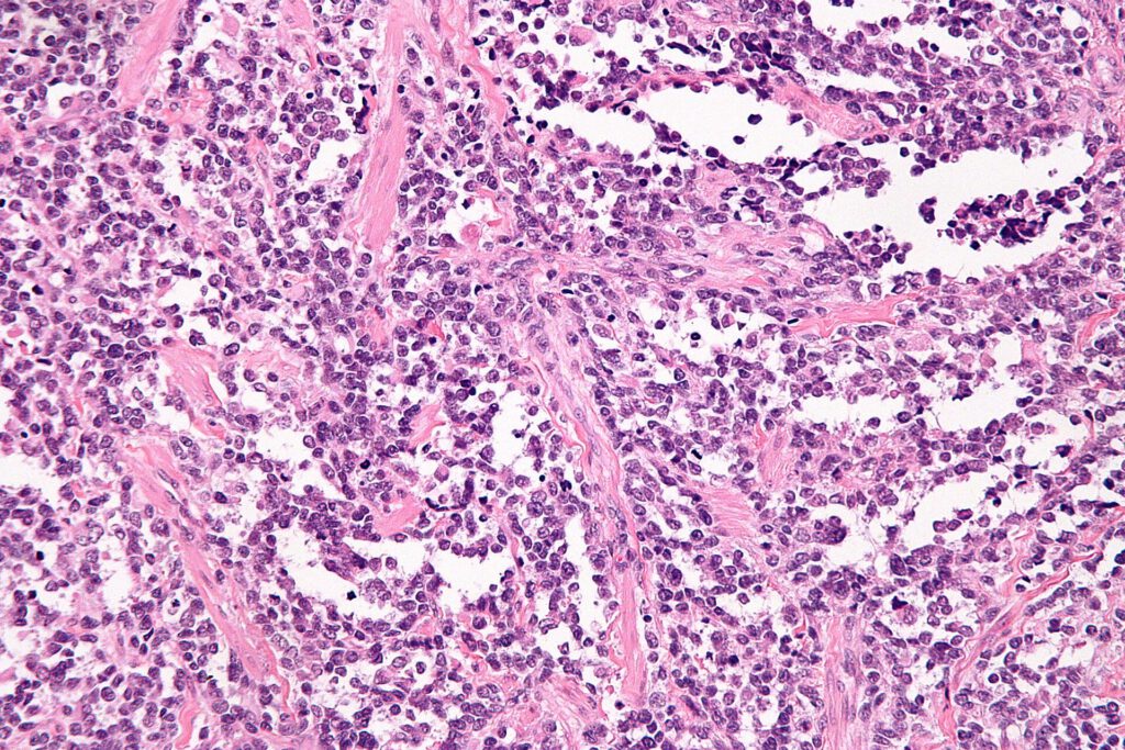 Hidden Aggressive Cells Explain Deadly Childhood Cancer Outcomes Microscopic view of cancer cells showing aggressive growth patterns in childhood cancer research