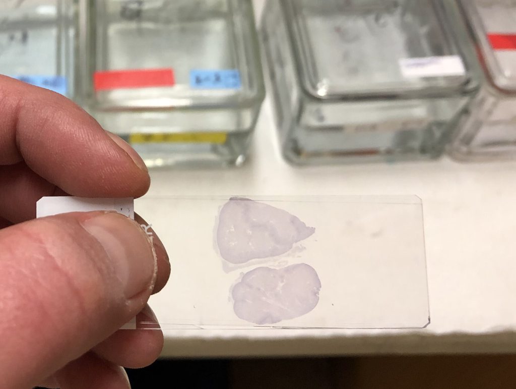 Psilocybin Study Shows Reduced Inflammation in Parkinson's Patients 3 Stained microscope slide