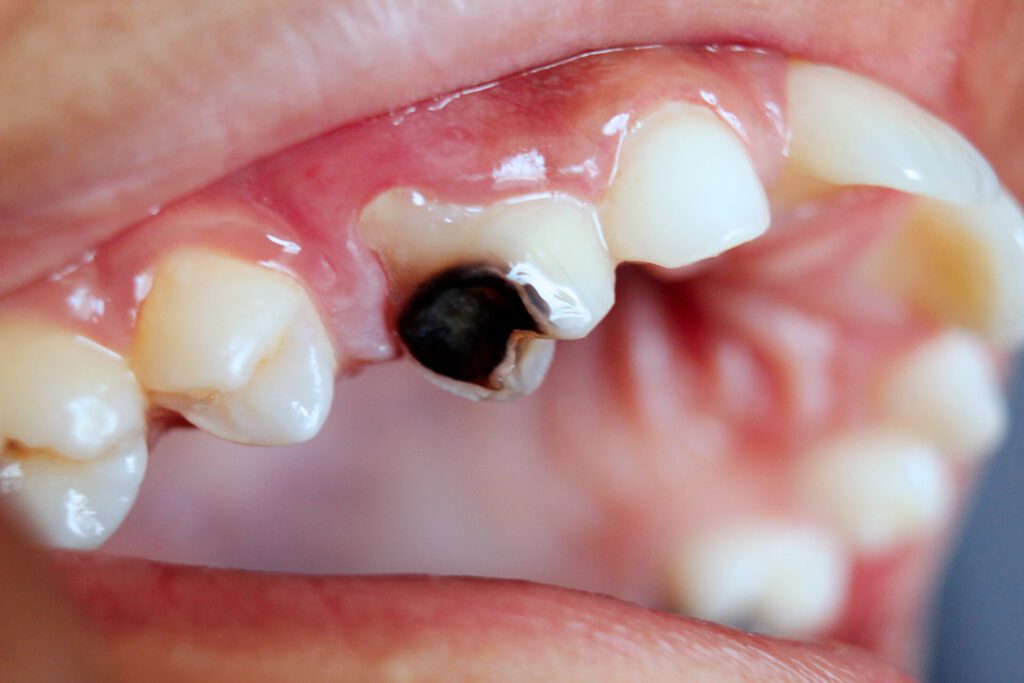 Dentist applying silver diamine fluoride liquid to a child's tooth
