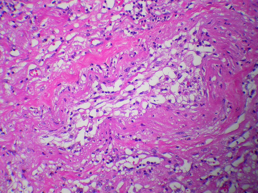 One Week of Strength Training Shrinks Fat Cells in Mice 1 Adipose tissue embolus