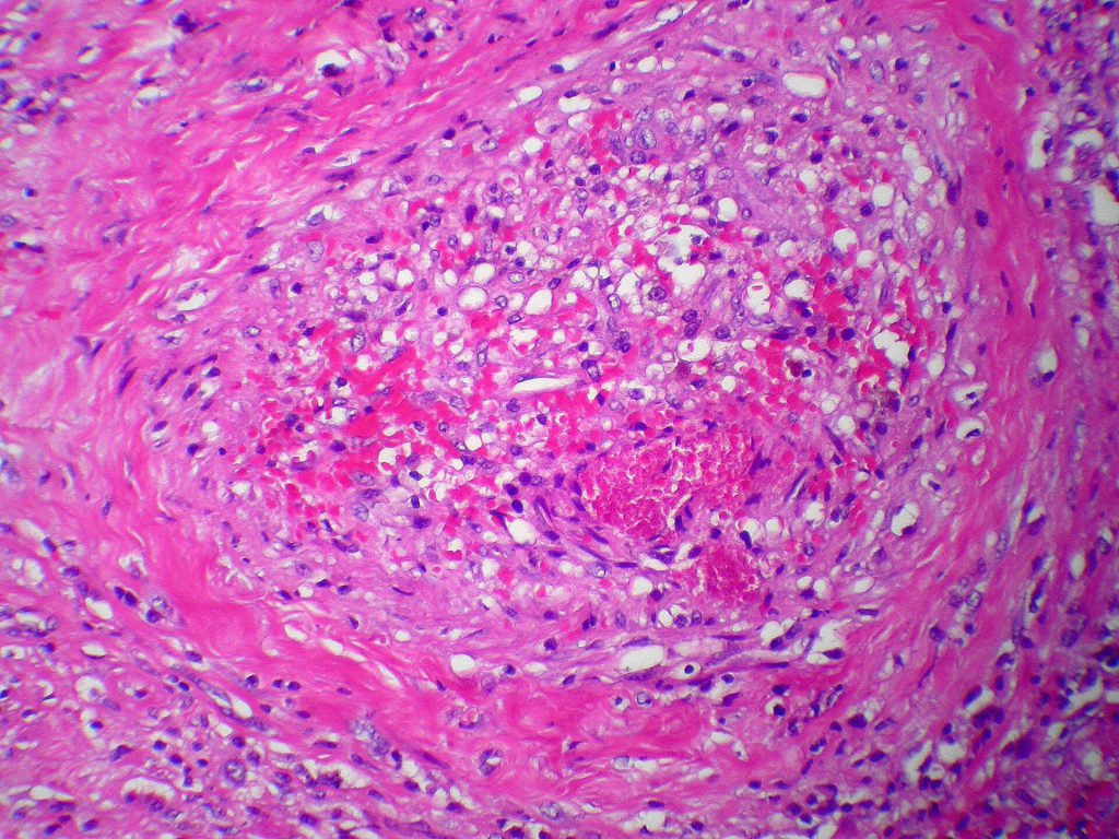 One Week of Strength Training Shrinks Fat Cells in Mice 2 Adipose tissue embolus Case 104